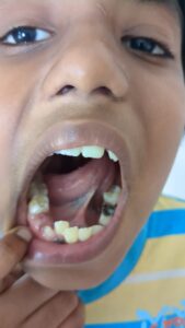 Homoeopathy for Pica and Dental Caries